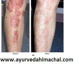 AROGYAM PURE HERBS KIT FOR PSORIASIS